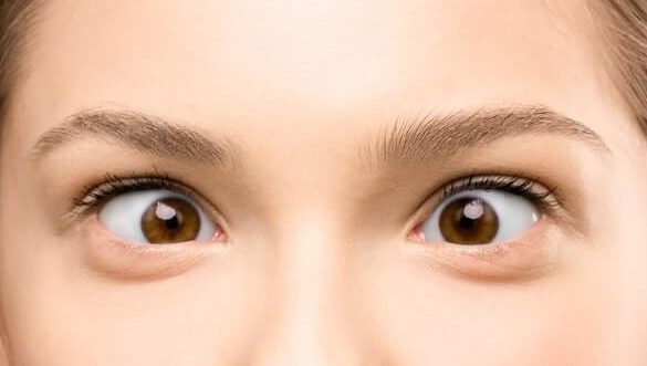 Strabismus (Crossed Eyes) and Amblyopia (Lazy Eyes) in PRIMARYCITY