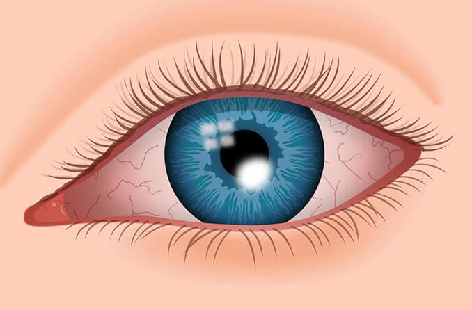 What is a corneal ulcer? Is it an eye emergency? in PRIMARYCITY