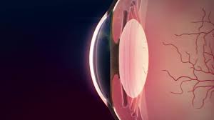 What are the symptoms of a corneal ulcer?